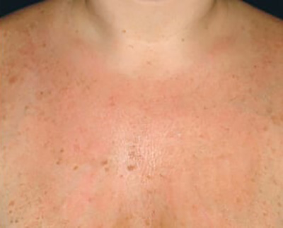 Forever Young BBL™ Photo Facial - Actual Patient Results - After - 1