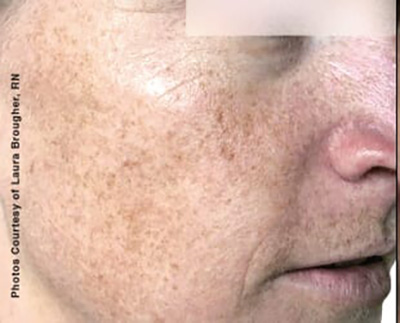 Forever Young BBL™ Photo Facial - Actual Patient Results - Before - 2