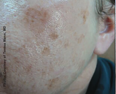 Forever Young BBL™ Photo Facial - Actual Patient Results - Before - 3