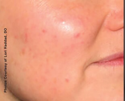 Forever Young BBL™ Photo Facial - Actual Patient Results - Before - 4