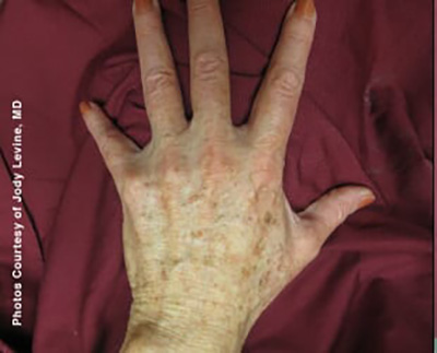 Forever Young BBL™ Photo Facial - Actual Patient Results - Before - 5