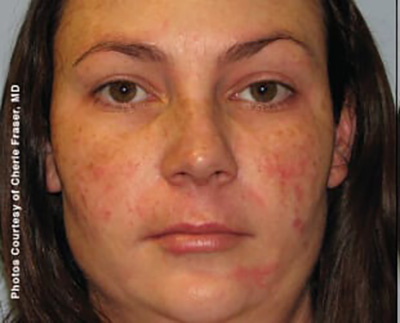 Forever Young BBL™ Photo Facial - Actual Patient Results - Before - 6