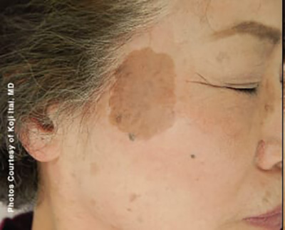 Forever Young BBL™ Photo Facial - Actual Patient Results - Before - 7