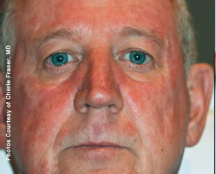 Forever Young BBL™ Photo Facial - Actual Patient Results - Before - 8