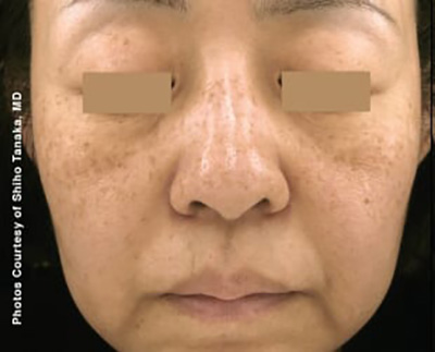 Forever Young BBL™ Photo Facial - Actual Patient Results - Before - 9