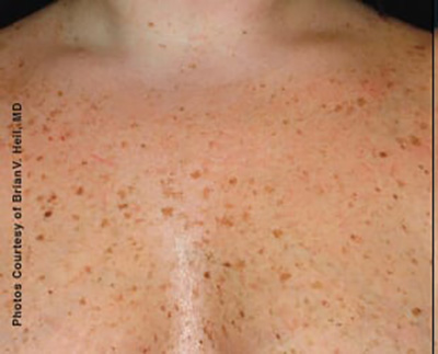 Forever Young BBL™ Photo Facial - Actual Patient Results - Before - 1