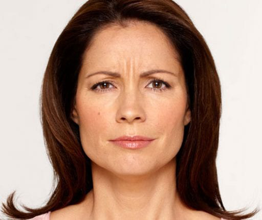 BOTOX® Cosmetic - Actual Patient Results - Before - 1