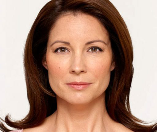 BOTOX® Cosmetic - Actual Patient Results - After - 1