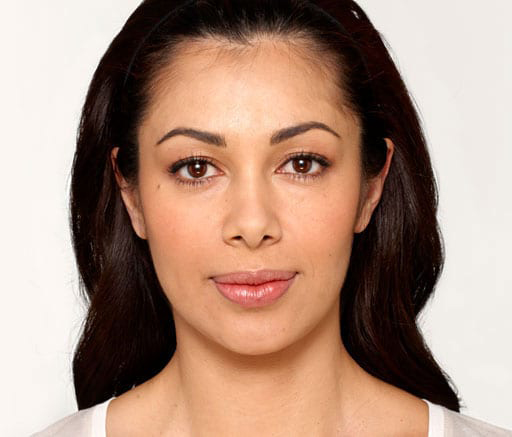 BOTOX® Cosmetic - Actual Patient Results - After - 2