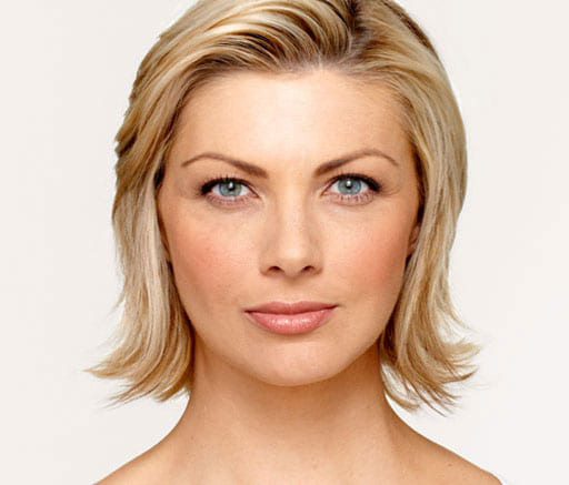 BOTOX® Cosmetic - Actual Patient Results - After - 3
