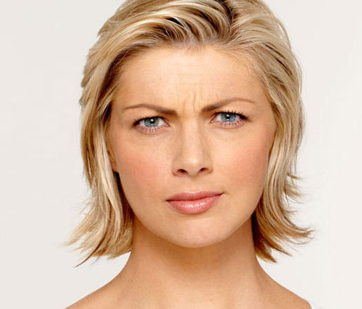 BOTOX® Cosmetic - Actual Patient Results - Before - 3