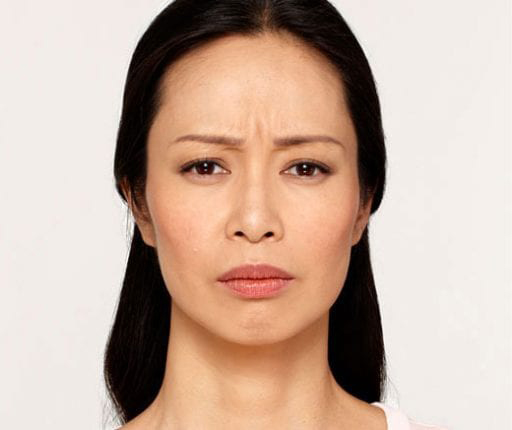 BOTOX® Cosmetic - Actual Patient Results - Before - 4