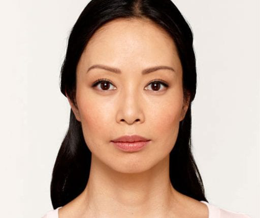 BOTOX® Cosmetic - Actual Patient Results - After - 4