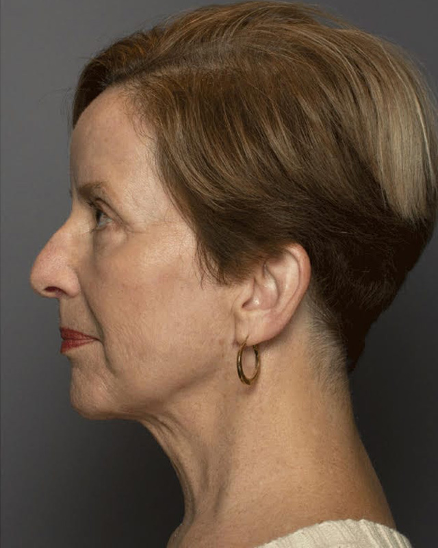 Facial Rejuvenation With Embrace™ - Actual Patient Results - After - 1