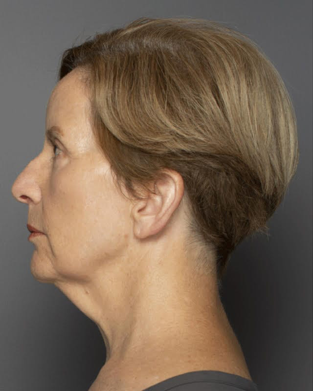 Facial Rejuvenation With Embrace™ - Actual Patient Results - Before - 1