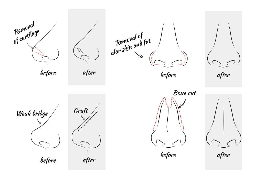 Drawings of different nose shaping techniques