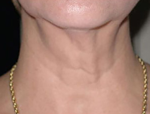 SkinTyte II - Actual Patient Results - After - 1