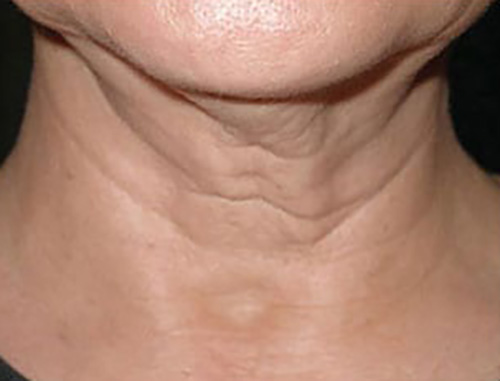 SkinTyte II - Actual Patient Results - Before - 1