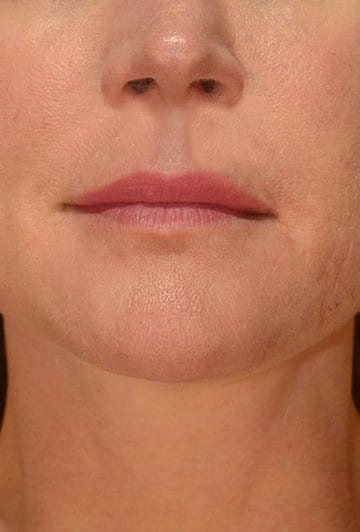 Dermal Fillers - Actual Patient Results - After - 1