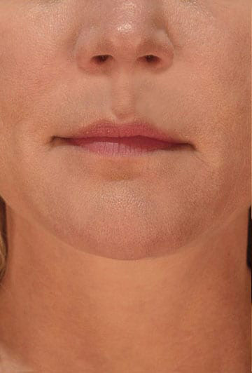 Dermal Fillers - Actual Patient Results - Before - 1