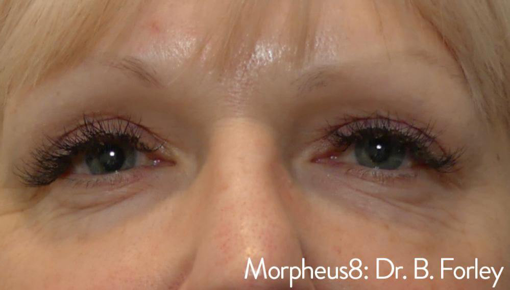 Morpheus8 - Actual Patient Results - After - 2