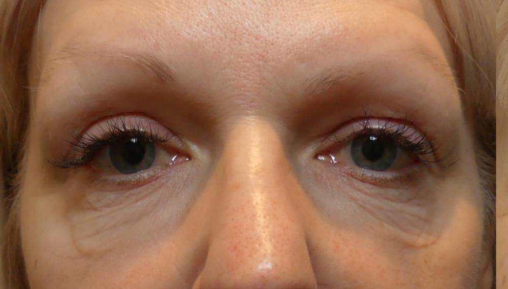 Morpheus8 - Actual Patient Results - Before - 2