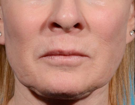 Morpheus8 - Actual Patient Results - Before - 4