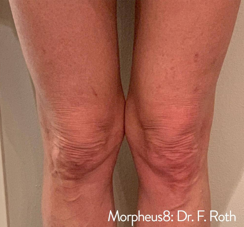 Morpheus8 - Actual Patient Results - After - 7