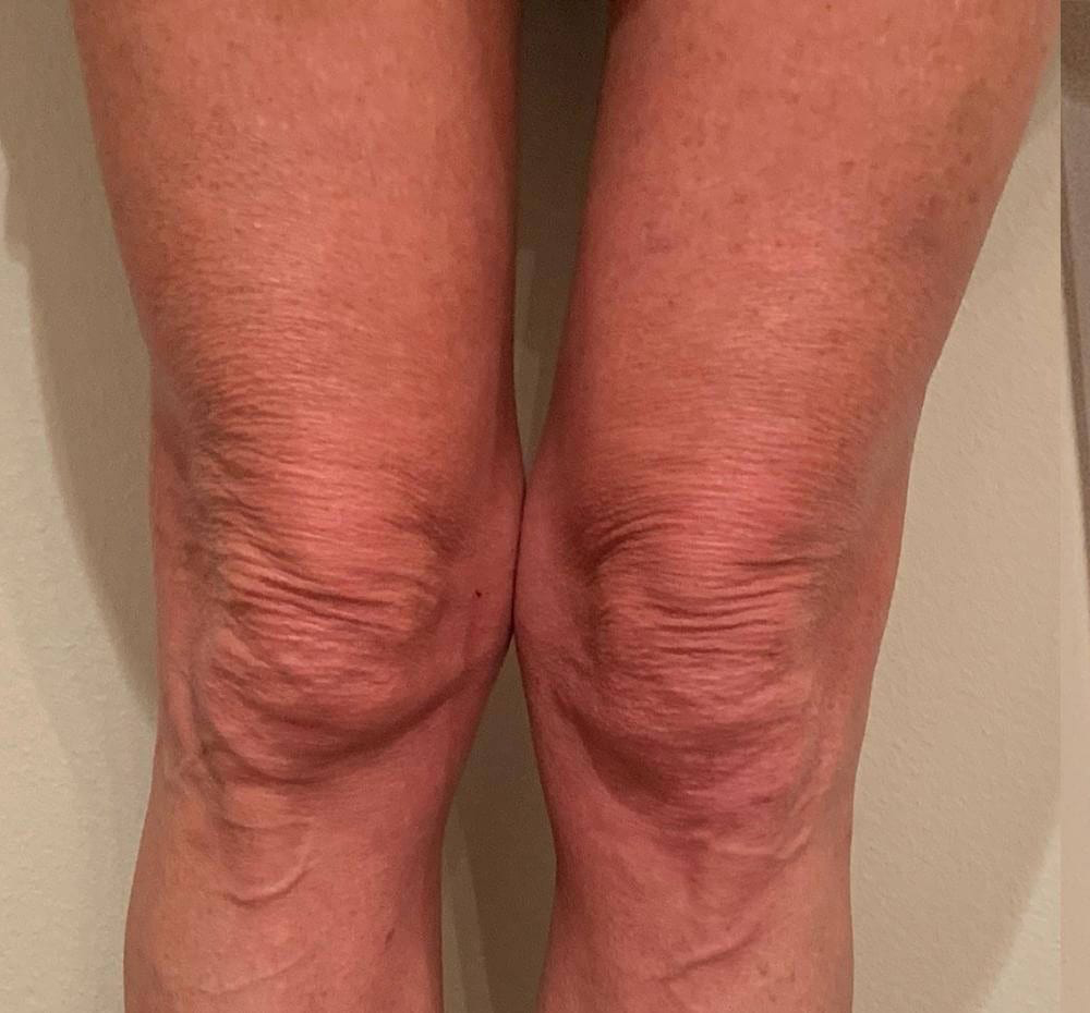 Morpheus8 - Actual Patient Results - Before - 7