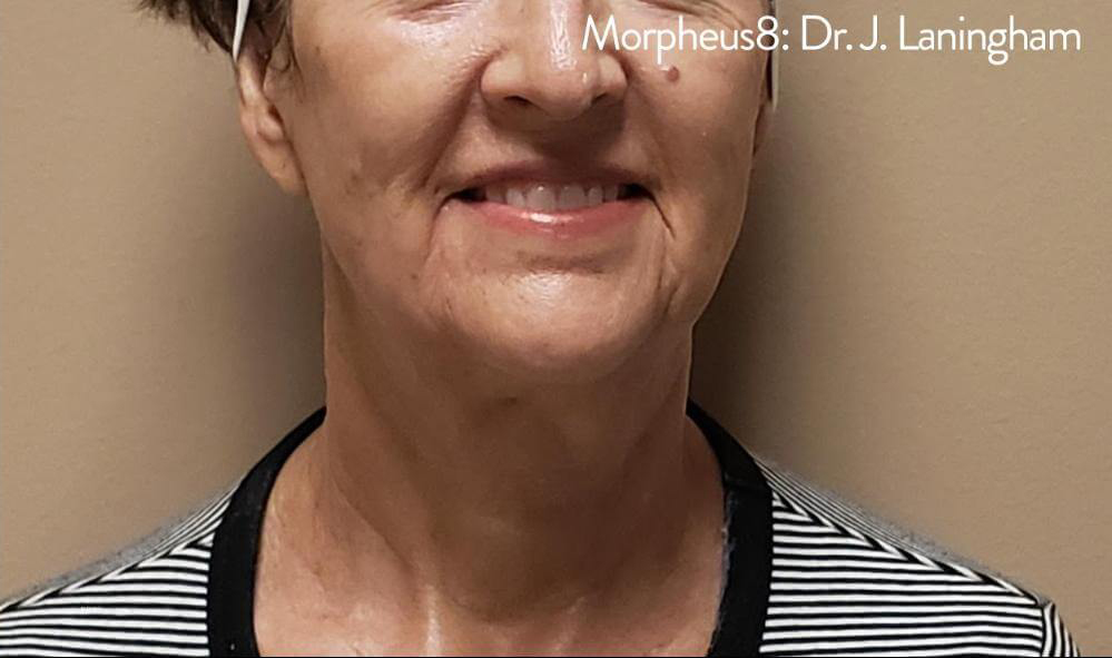 Morpheus8 - Actual Patient Results - After - 6