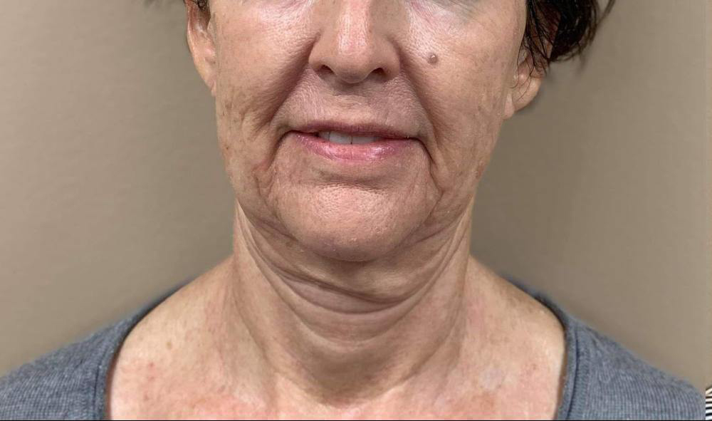 Morpheus8 - Actual Patient Results - Before - 6