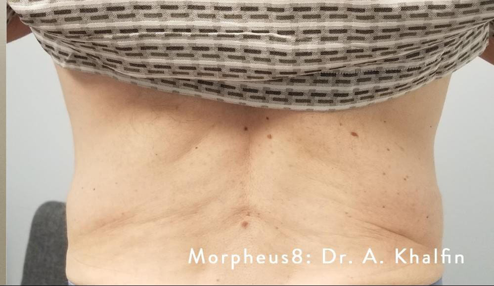 Morpheus8 - Actual Patient Results - After - 3