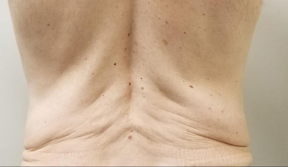 Morpheus8 - Actual Patient Results - Before - 3