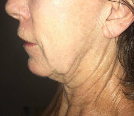 Morpheus8 - Actual Patient Results - Before - 1