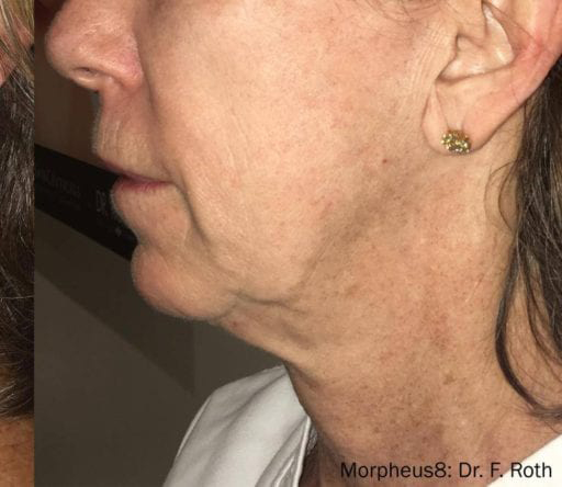 Morpheus8 - Actual Patient Results - After - 1