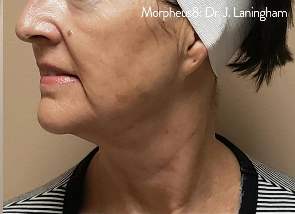 Morpheus8 - Actual Patient Results - After - 5
