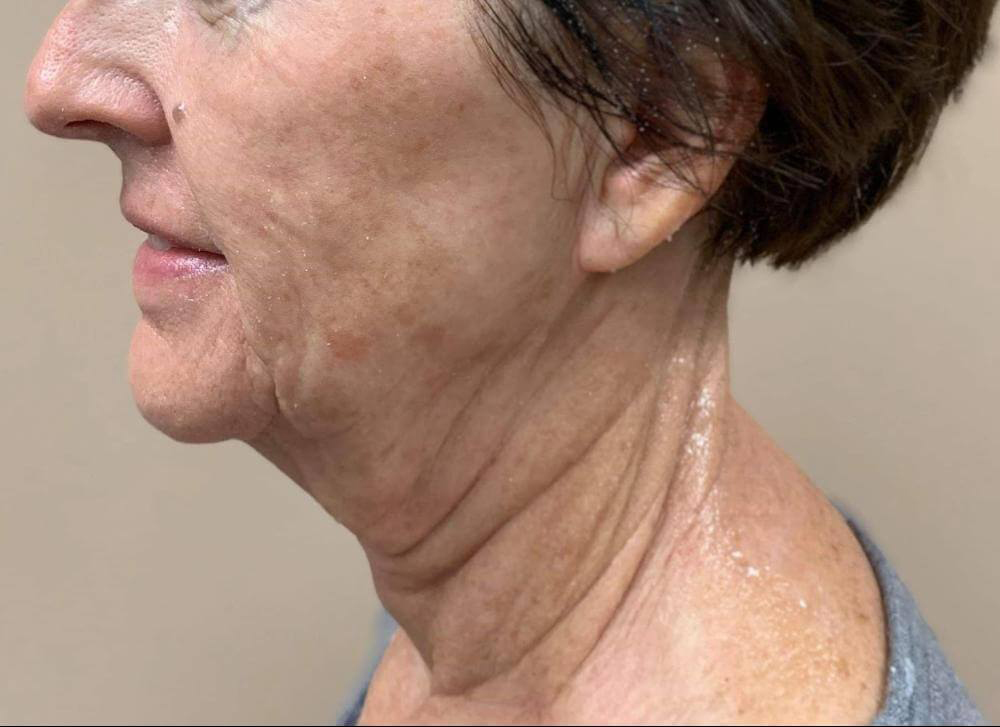 Morpheus8 - Actual Patient Results - Before - 5