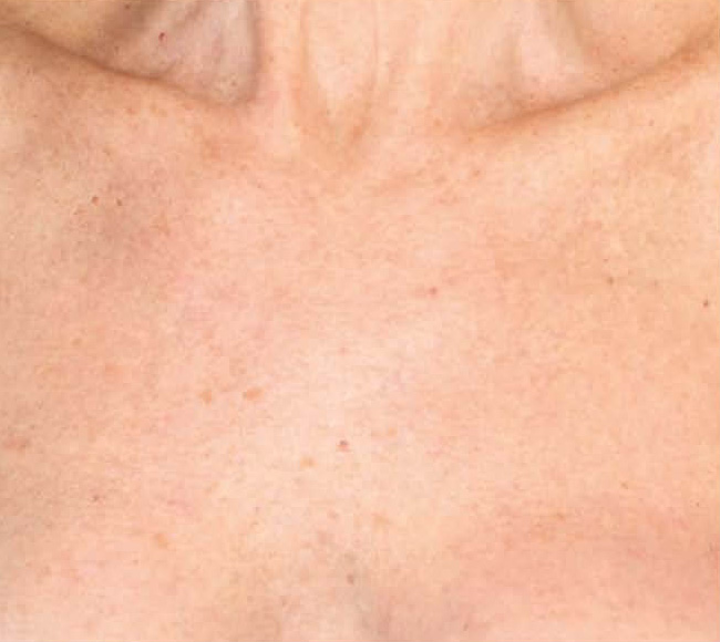 BBL® HERO™ in Bellevue, WA - Actual Patient Results - After - 2