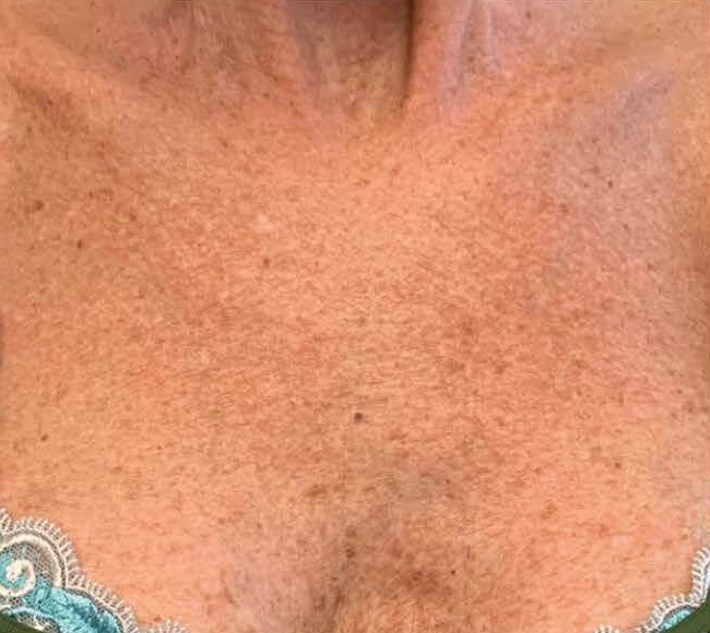 BBL® HERO™ in Bellevue, WA - Actual Patient Results - Before - 2