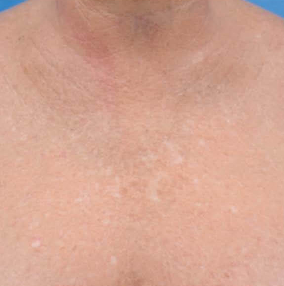 BBL® HERO™ in Bellevue, WA - Actual Patient Results - After - 4