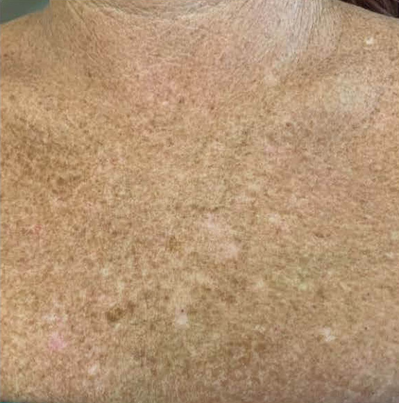 BBL® HERO™ in Bellevue, WA - Actual Patient Results - Before - 4