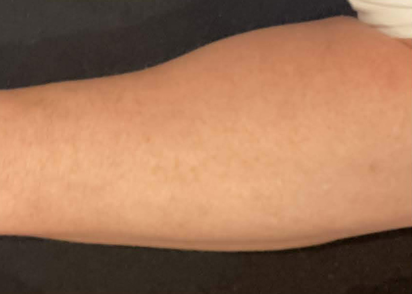 BBL® HERO™ in Bellevue, WA - Actual Patient Results - After - 5