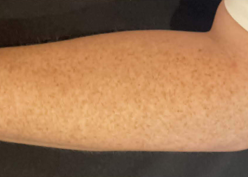 BBL® HERO™ in Bellevue, WA - Actual Patient Results - Before - 5