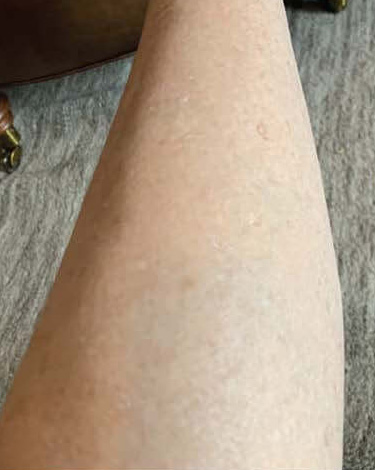 BBL® HERO™ in Bellevue, WA - Actual Patient Results - After - 3