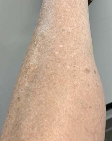 BBL® HERO™ in Bellevue, WA - Actual Patient Results - Before - 3