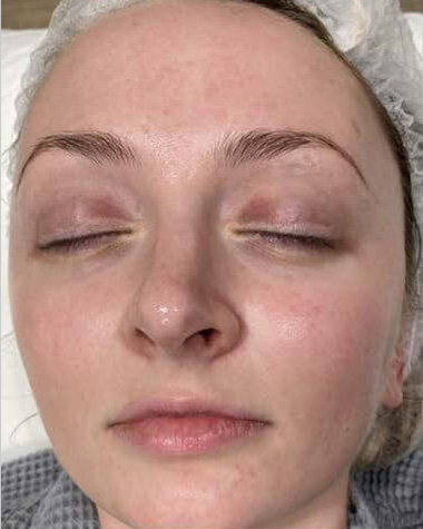 BBL® HERO™ in Bellevue, WA - Actual Patient Results - After - 1