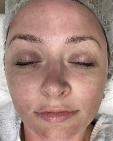 BBL® HERO™ in Bellevue, WA - Actual Patient Results - Before - 1