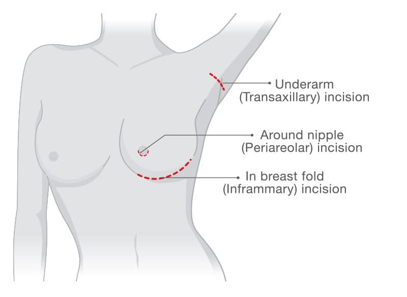 Incision diagram