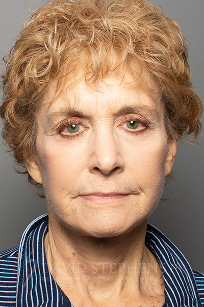 Facelift-Patient-12 | After Facelift