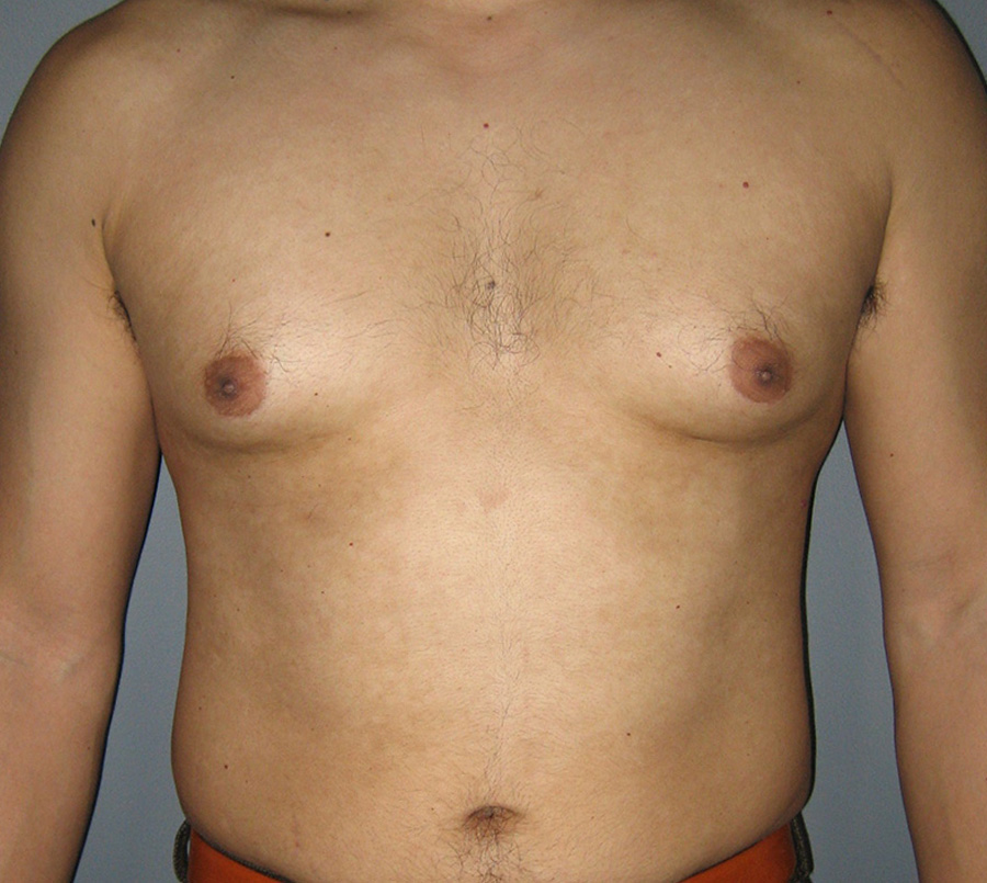 Gynecomastia-Patient-11 | Before Gynecomastia
